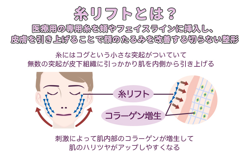 糸リフトとは？ 医療用の専用糸を頬やフェイスラインに挿入し、 皮膚を引き上げることで顔のたるみを改善する切らない整形