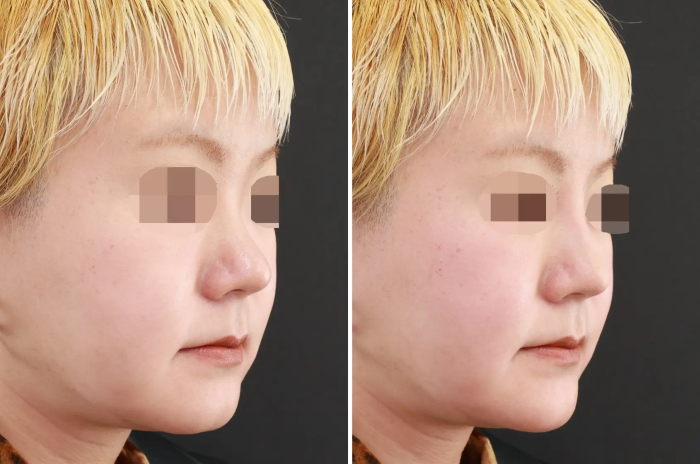 TAクリニック：鼻のヒアルロン酸注射・あごのヒアルロン酸注射の症例写真