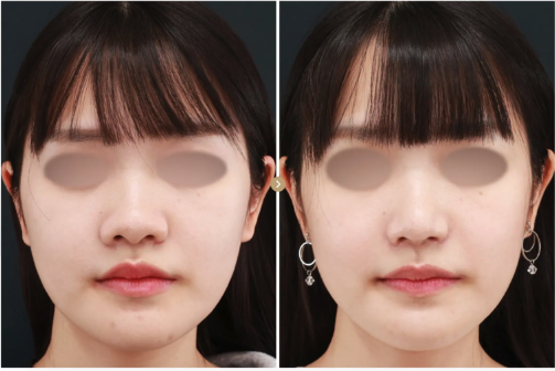 鼻孔縁挙上術の症例写真