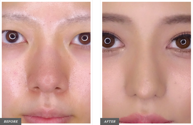 TCB東京中央美容外科：　鼻翼縮小完全内側法の症例写真