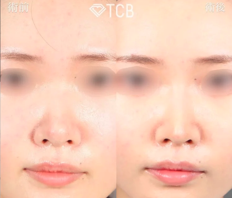 TCB東京中央美容外科のTCBメッシュの症例写真