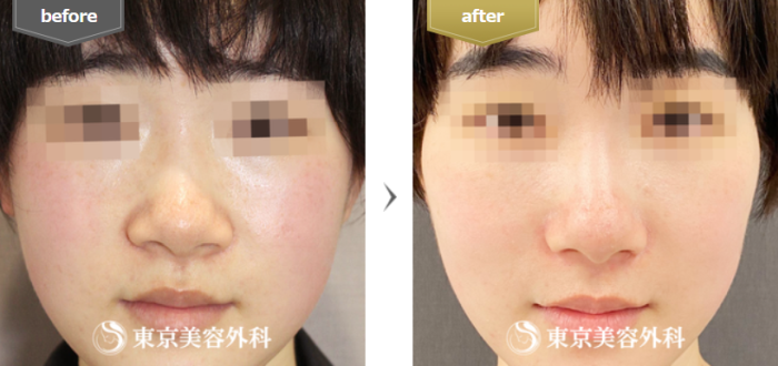 東京美容外科：小鼻縮小　の症例写真