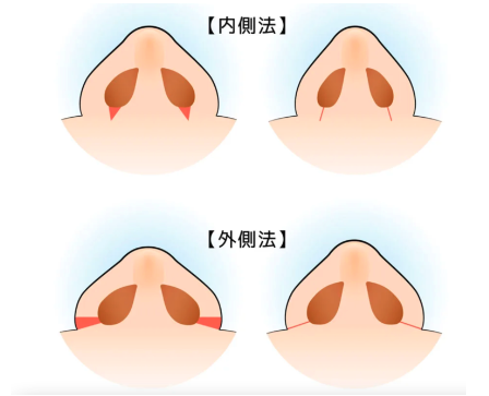TAC式鼻翼縮小術（小鼻縮小）