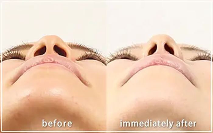 共立美容外科：小鼻縮小の症例写真