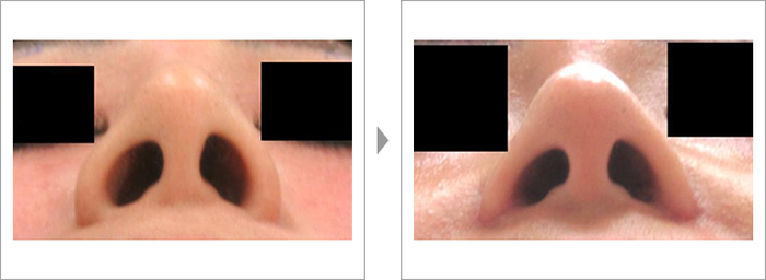 品川美容外科：　小鼻縮小の症例写真