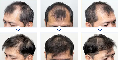 親和クリニックの植毛40代男性（総額1,408,000円）の症例3パターン