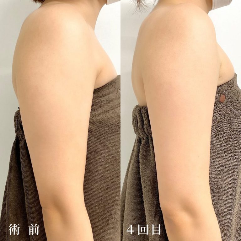 TCB東京中央美容外科のVFDI人参注射の症例写真