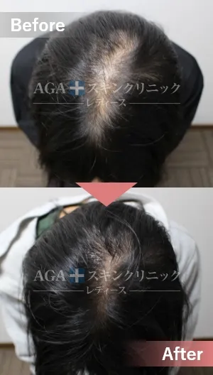 AGAスキンクリニックレディース-内服薬+ミノキジェットの症例写真