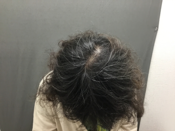 駅前AGAクリニック-オーダーメイドFAGA発毛セラピー+女性脱毛症治療薬(内服+外用)の症例写真②