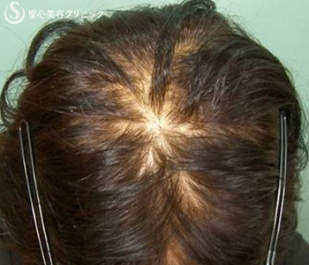 聖心毛髪再生外来-グロスファクター療法の症例写真①