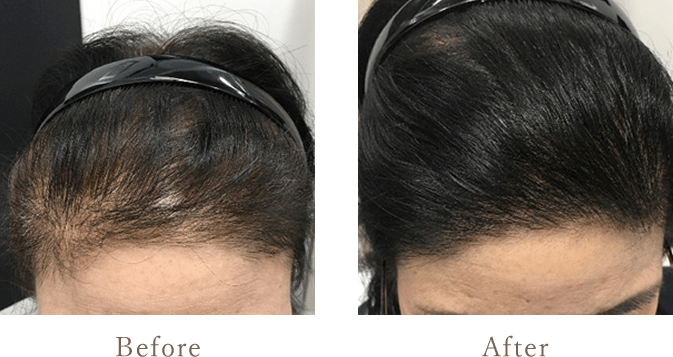 ウィルAGAクリニック-発毛トータルプレミアムコース　内服薬+最新LHDV頭皮注入治療の症例写真