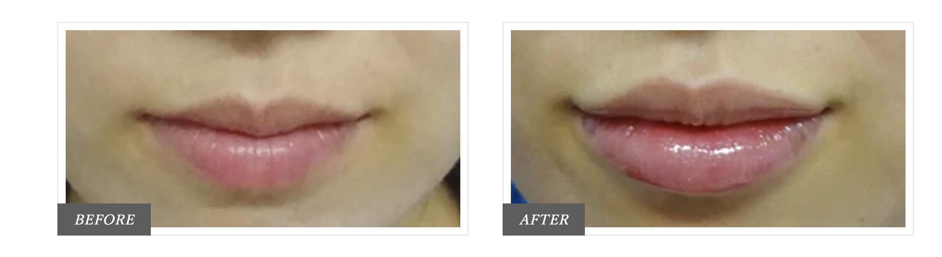TCB東京中央美容外科の唇のヒアルロン酸注射の症例写真