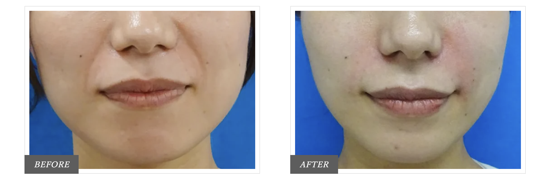 TCB東京中央美容外科のほうれい線のヒアルロン酸注射の症例写真
