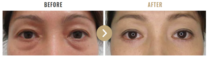 銀座TAクリニック嶽崎 元彦 医師の下眼瞼切開術と下眼瞼脱脂術の組み合わせの症例写真