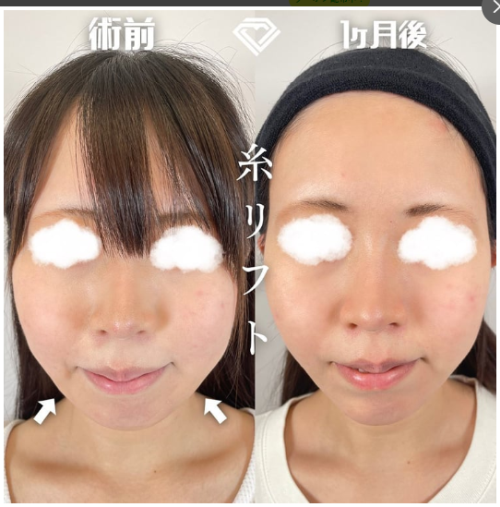 TCB東京中央美容外科の糸リフトの症例写真