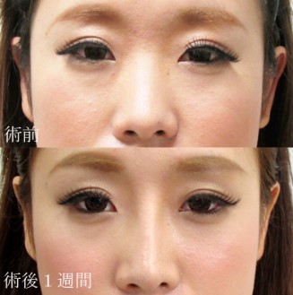 水の森美容外科の鼻プロテーゼ＋鼻中隔延長の症例写真