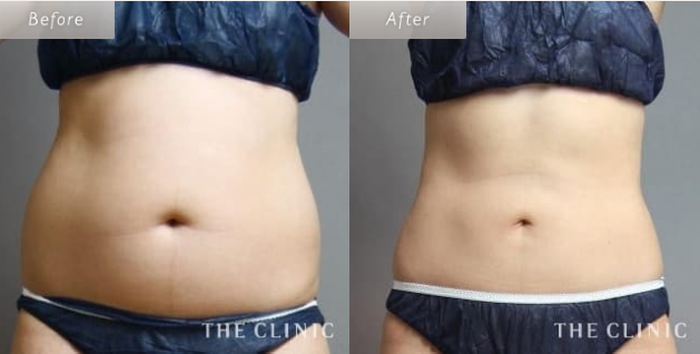 THE CLINIC 統括指導医 大橋 昌敬医師のベイザー脂肪吸引の症例写真