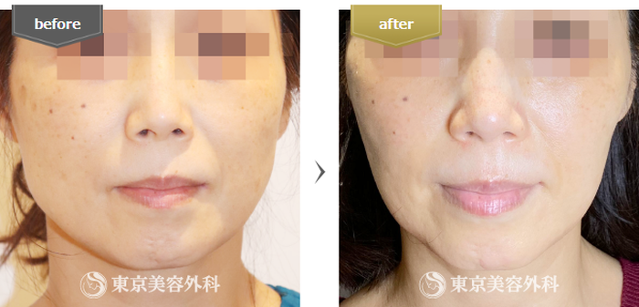 東京美容外科のエラボトックス注射の症例写真