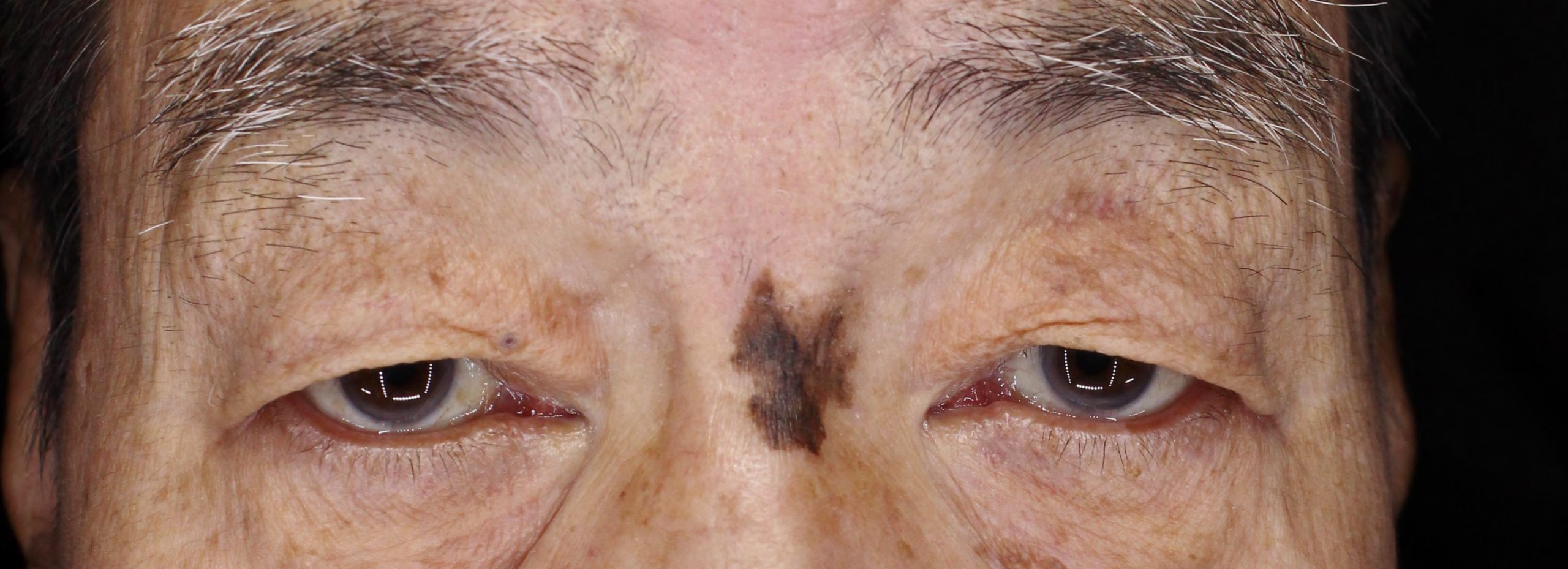 眼瞼下垂の手術前